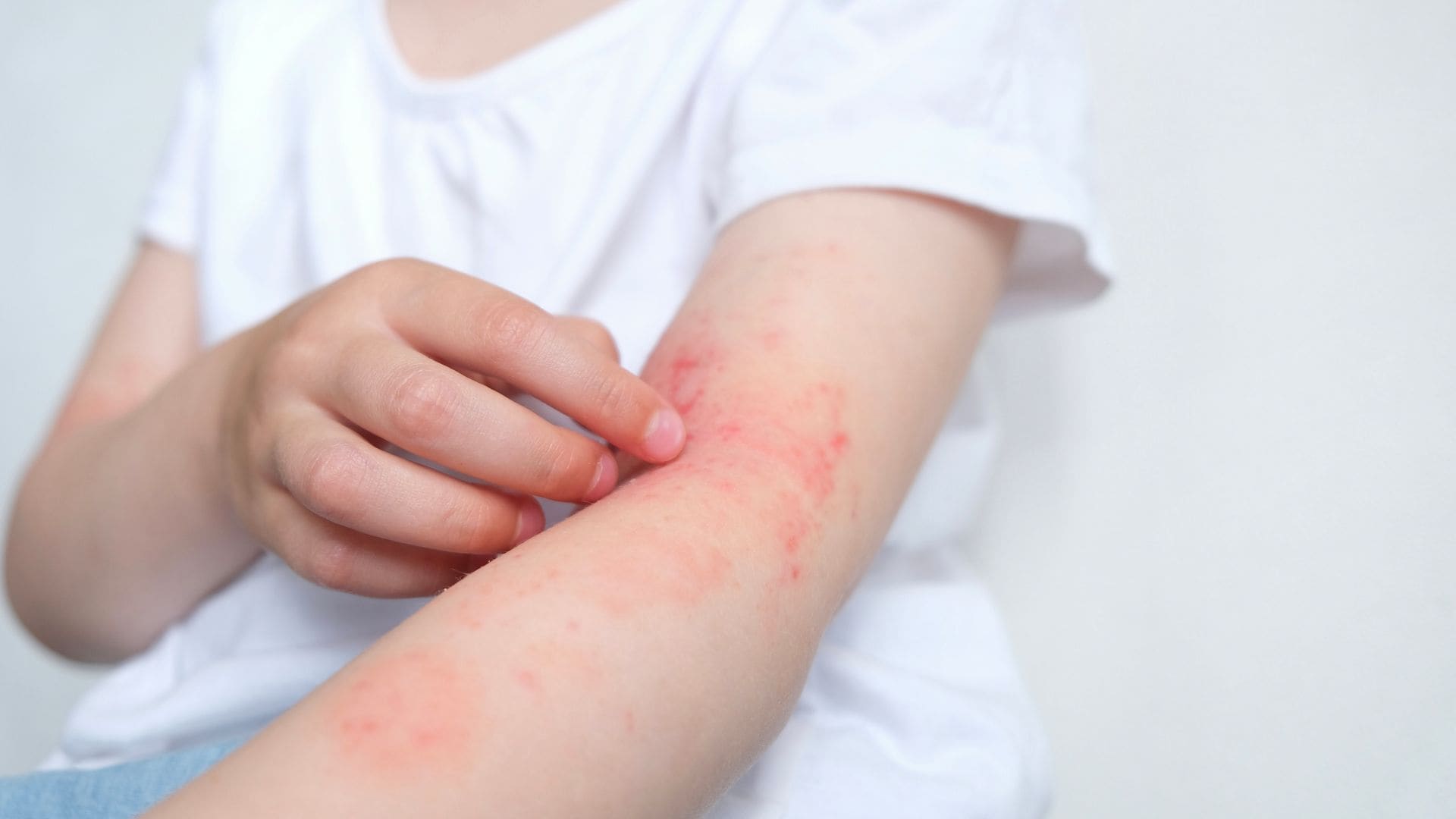 No es solo picor: así afecta la dermatitis atópica al estado de ánimo de los niños