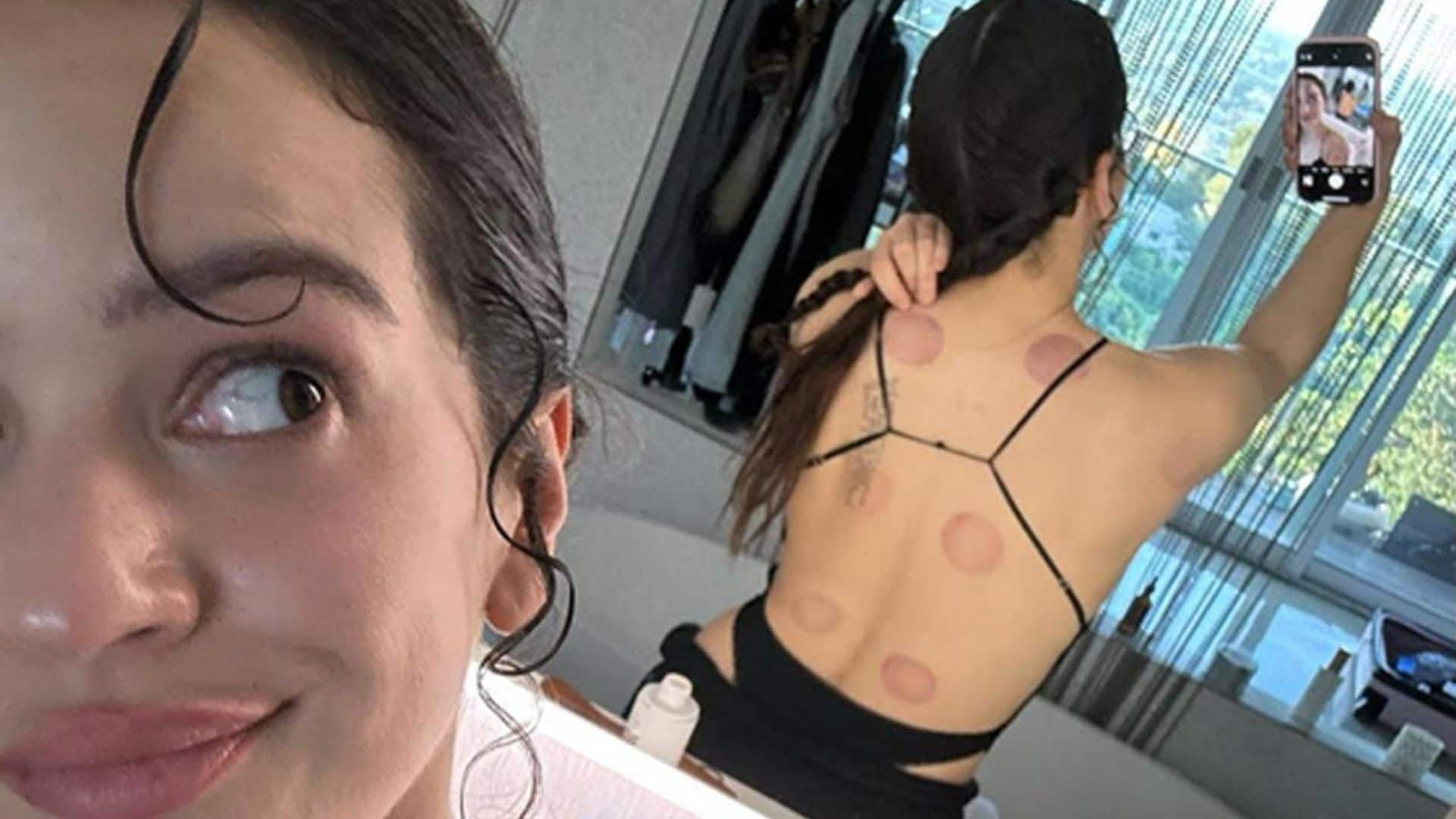 Te lo contamos todo sobre el 'cupping', la terapia que ya ha probado Rosalía