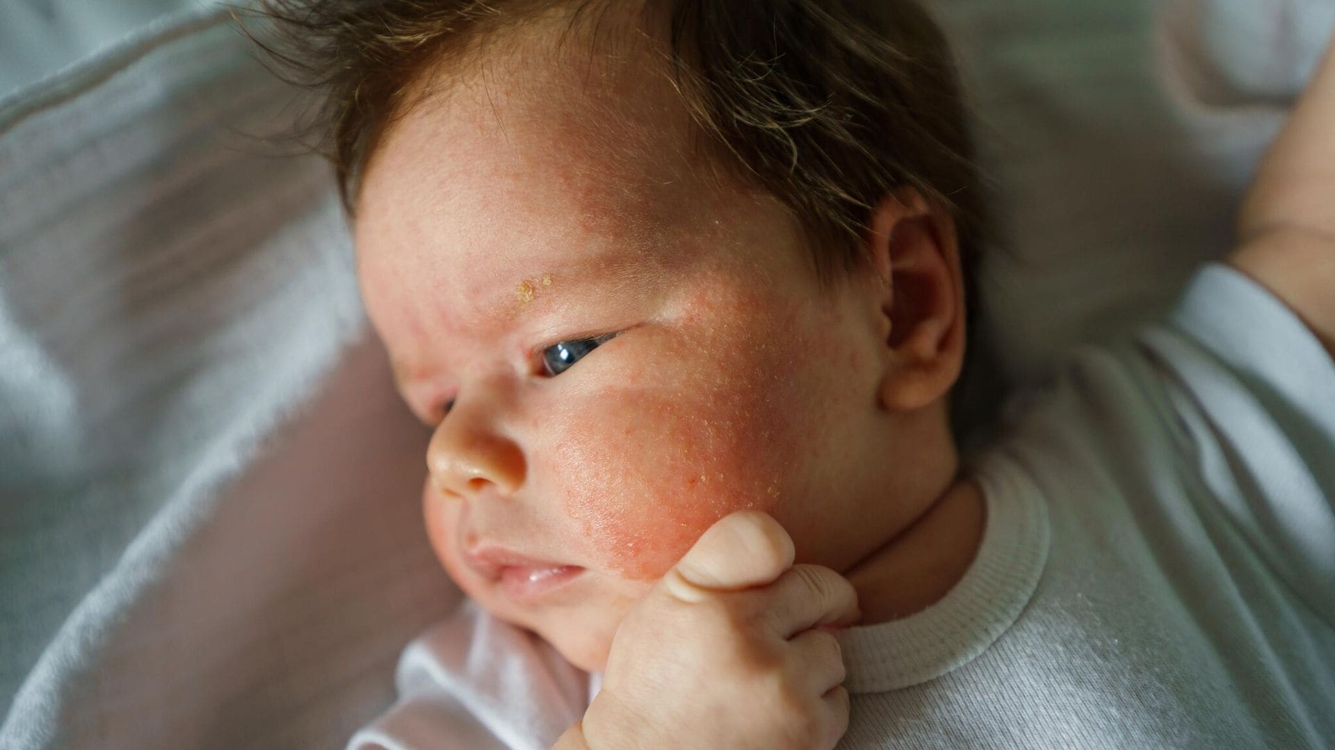Los probióticos ¿pueden frenar los eccemas en bebés y niños?
