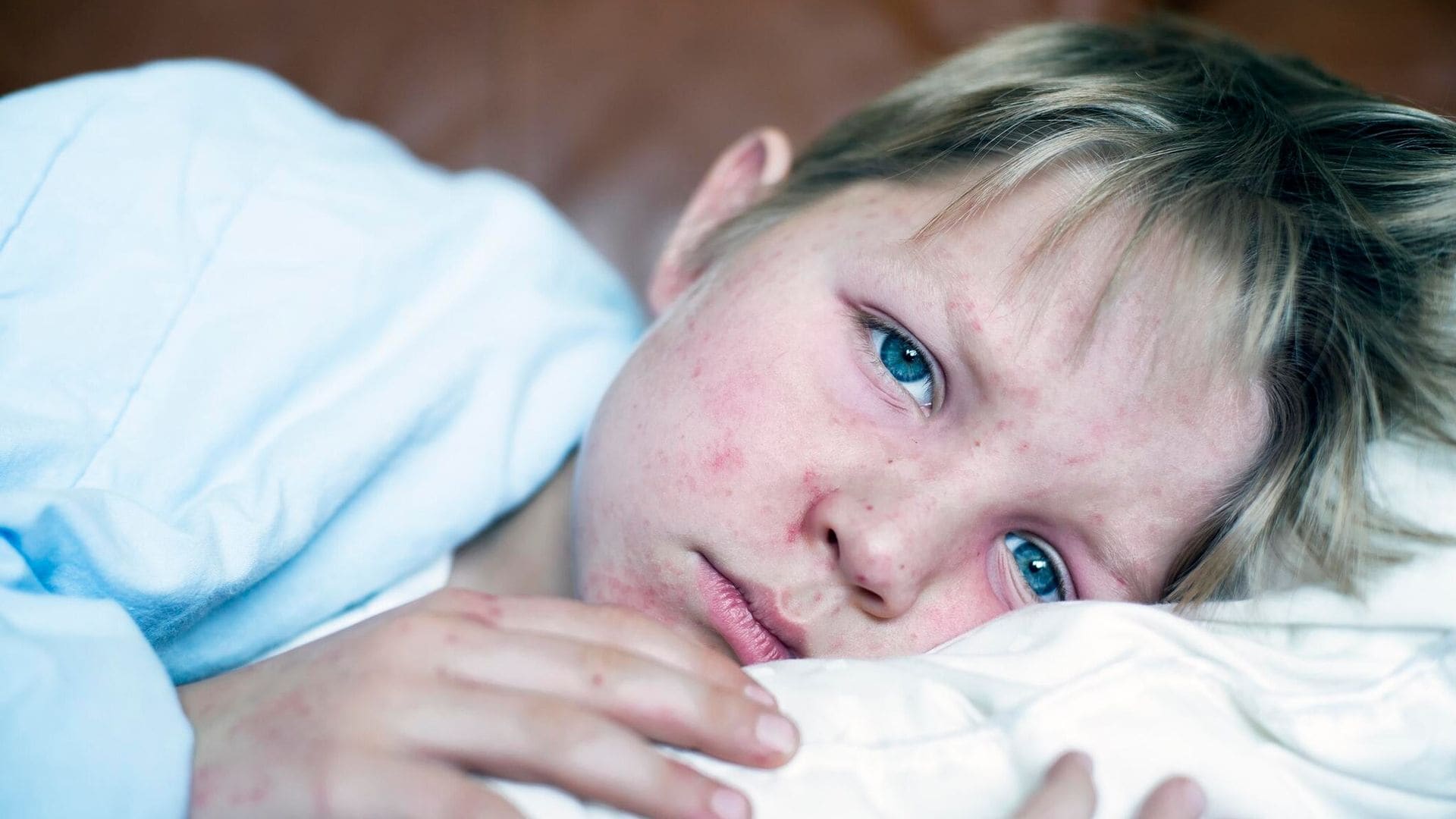 El sarampión, de nuevo en España: ¿qué riesgos implica para los niños si se contagian?