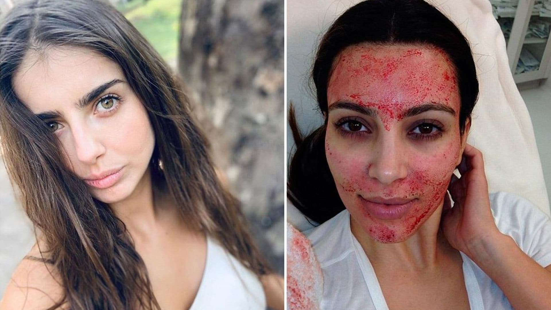 Michelle Renaud relató que se hizo el famoso 'facial vampiro', que Kim Kardashian puso de moda en 2013