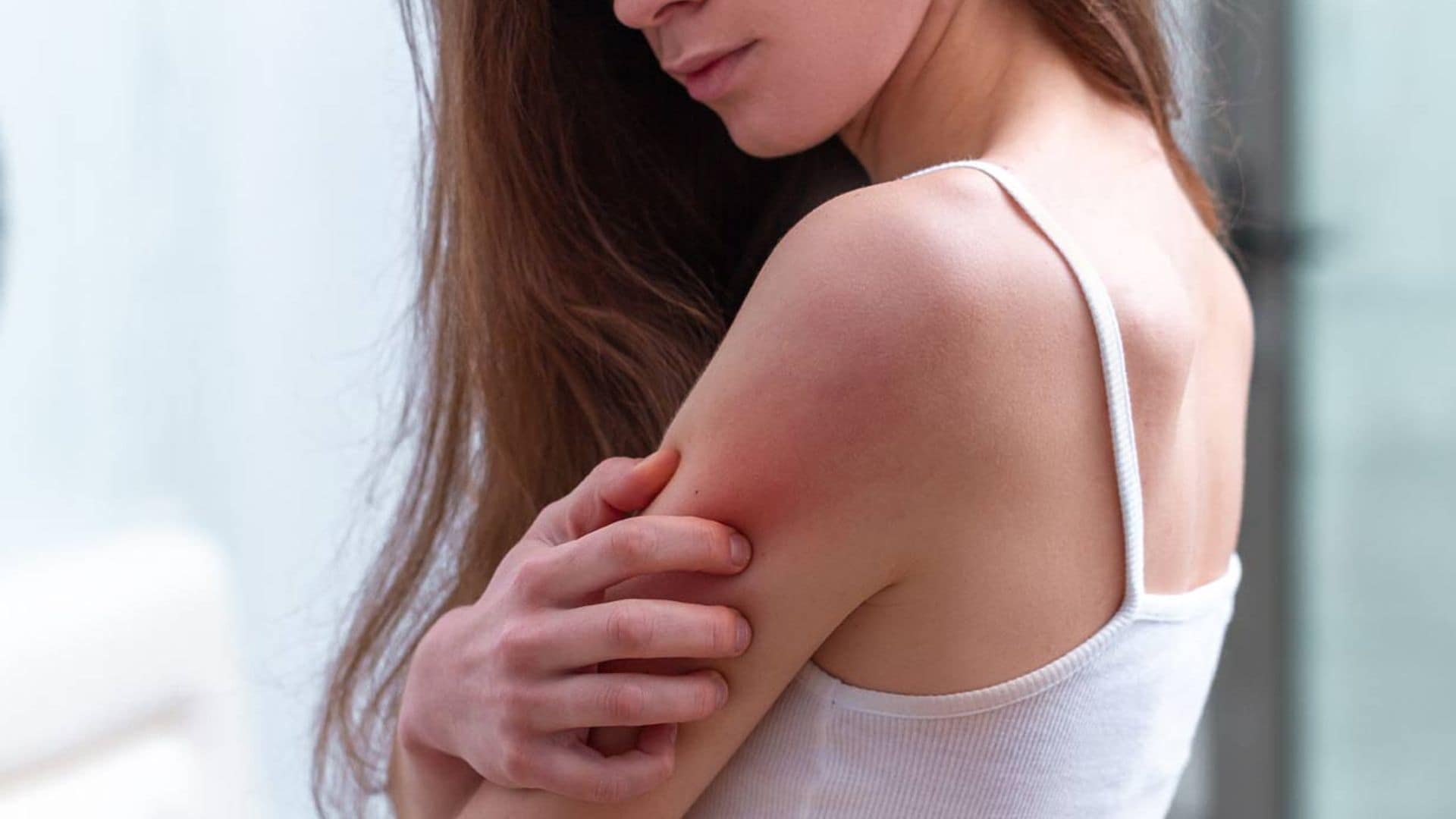 12 preguntas con respuesta sobre la dermatitis atópica