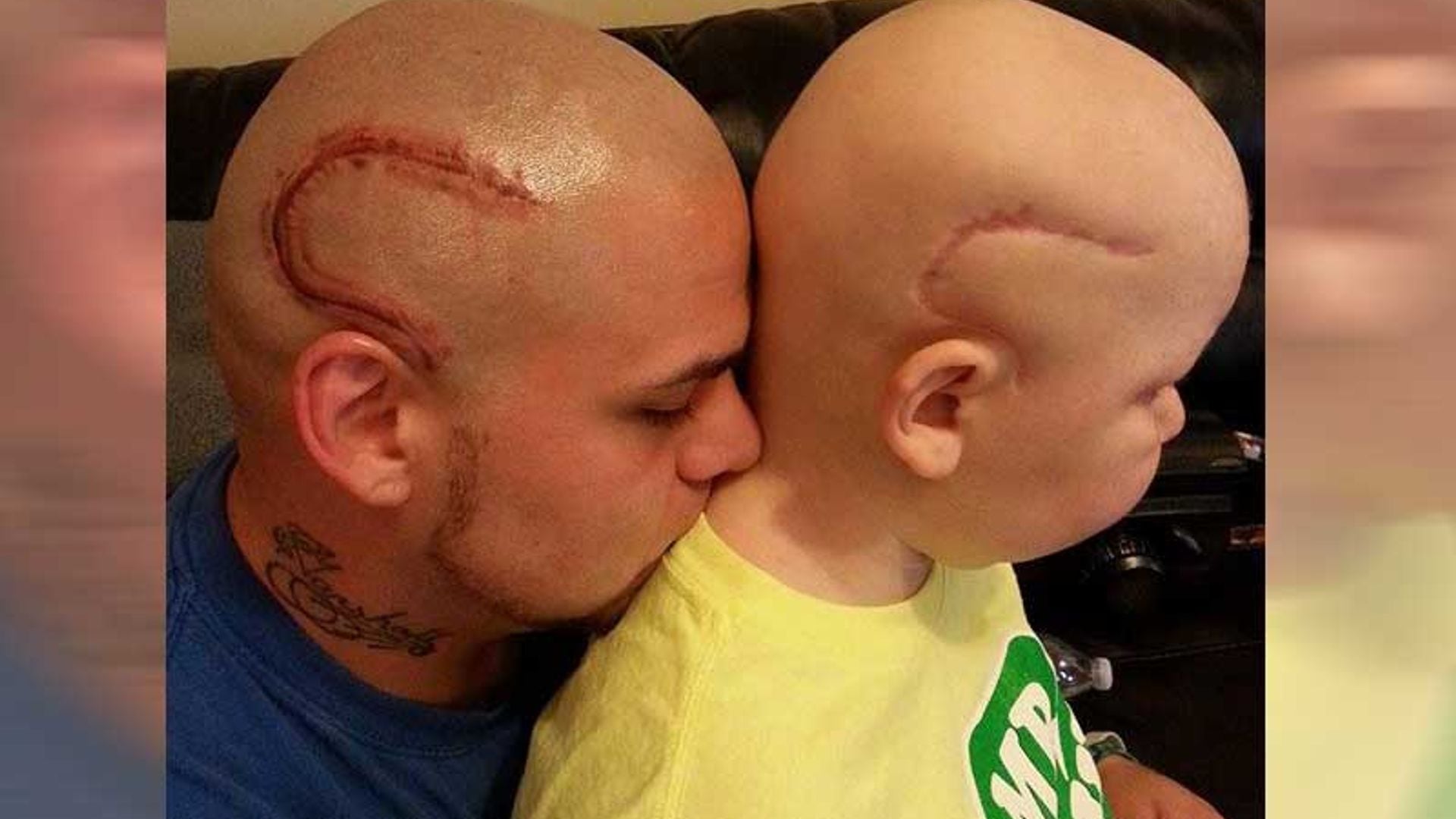 Él se tatuó la cicatriz de su hijo para apoyarlo en la lucha contra el cáncer