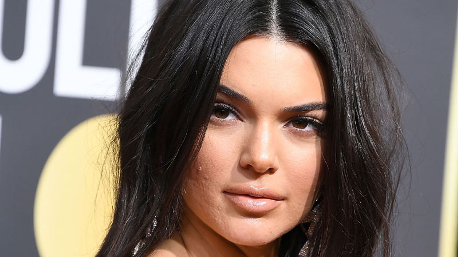 ¿Qué puedes hacer si tienes un brote de acné como el de Kendall Jenner?