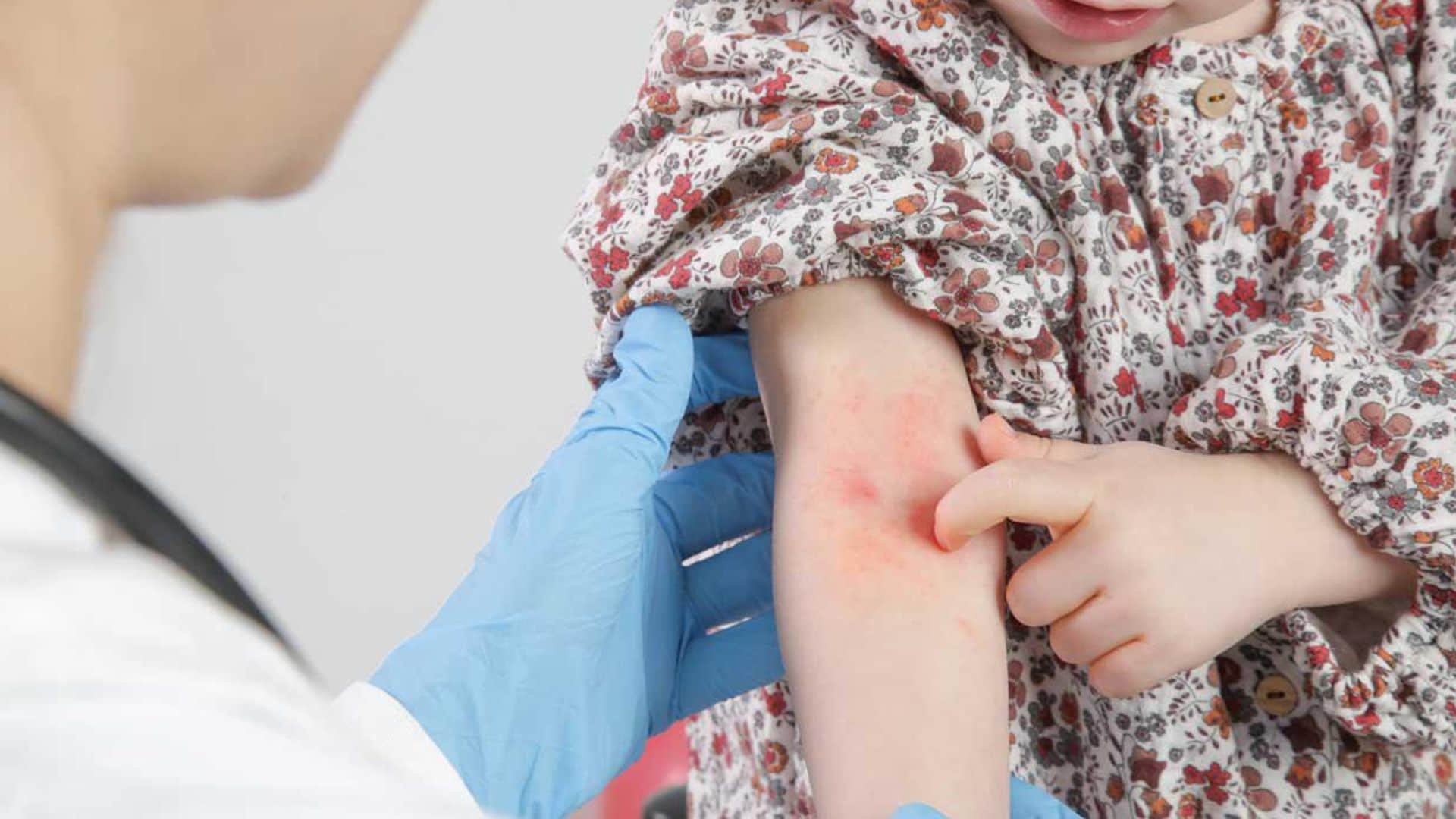 La psoriasis, más allá de una alteración en la piel: así afecta a los niños