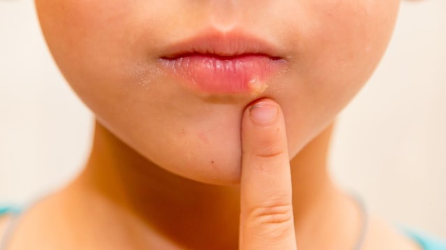 herpes labial infantil 