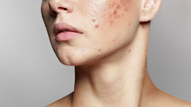 acne adultos