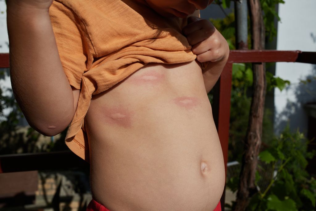 Niño con picaduras de mosquito en el torso