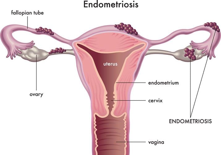 endometriosis-grafico