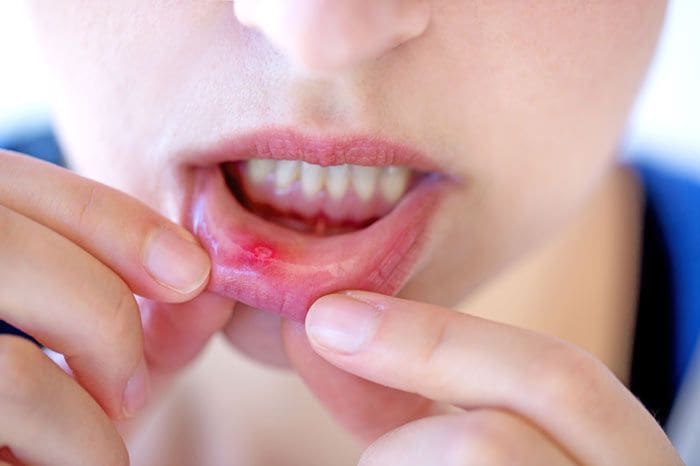 mujer con afta en el labio