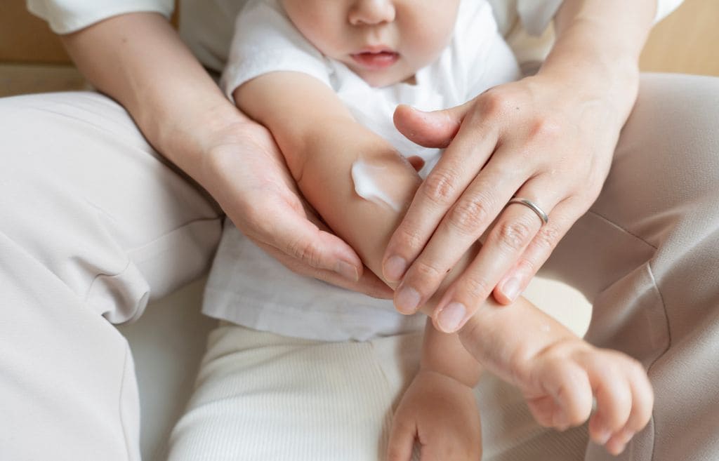 Niño con dermatitis atópica mientras le ponen crema