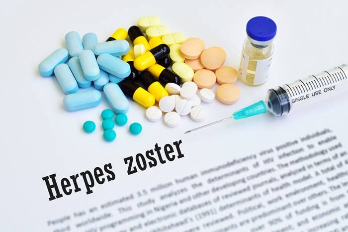 herpes zoster