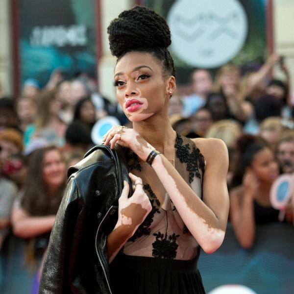 Chantelle Winnie, de 21 años, es la única modelo con vitíligo de la pasarela.
