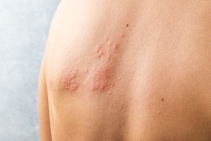 Este es el herpes de la varicela zóster que debes conocer