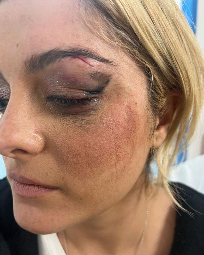 Le tienen que dar dos puntos a Bebe Rexha tras ser golpeada con un móvil