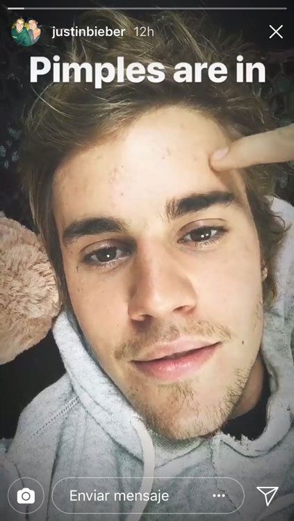 Justin Bieber enseña sus granos en Instagram