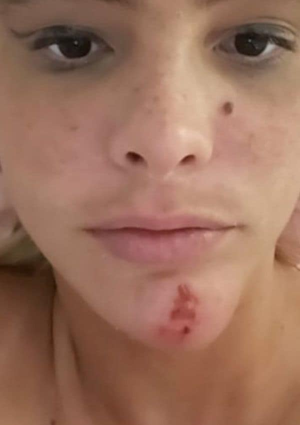 lele pons acne brote