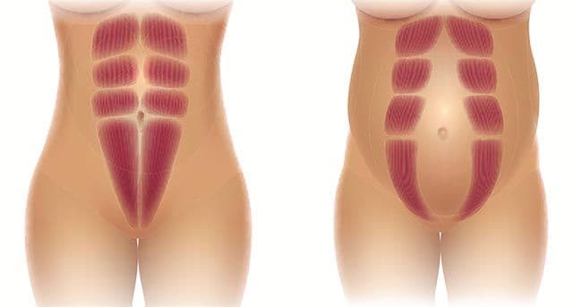 Así se produce la diástasis abdominal