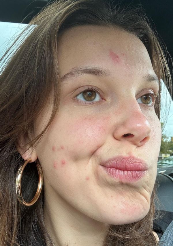 millie bobby brown acne