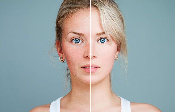 rosacea-tratamiento