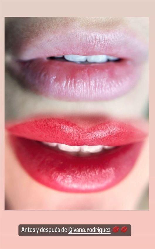 Ivana Rodríguez se hace microblanding de labios