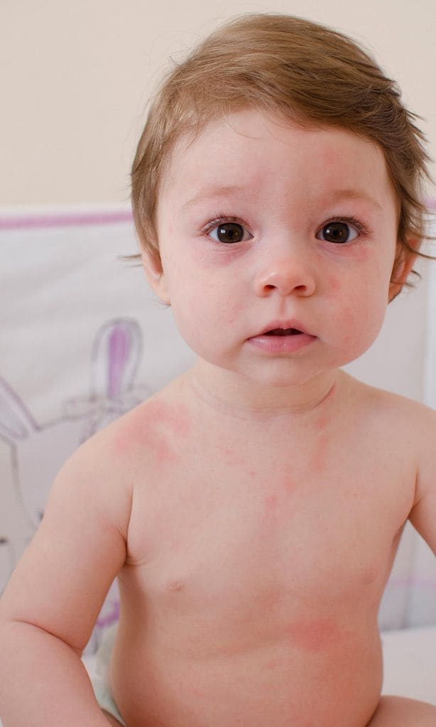 Niño sentado en su cuna con manchas rojas en la piel