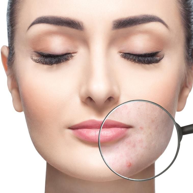mujer muestra brote de acn debajo del maquillaje