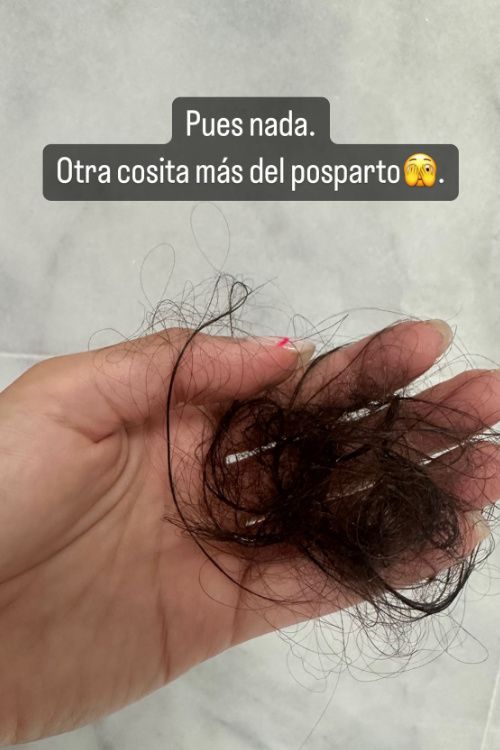 Cristina Pedroche muestra su caída de cabello