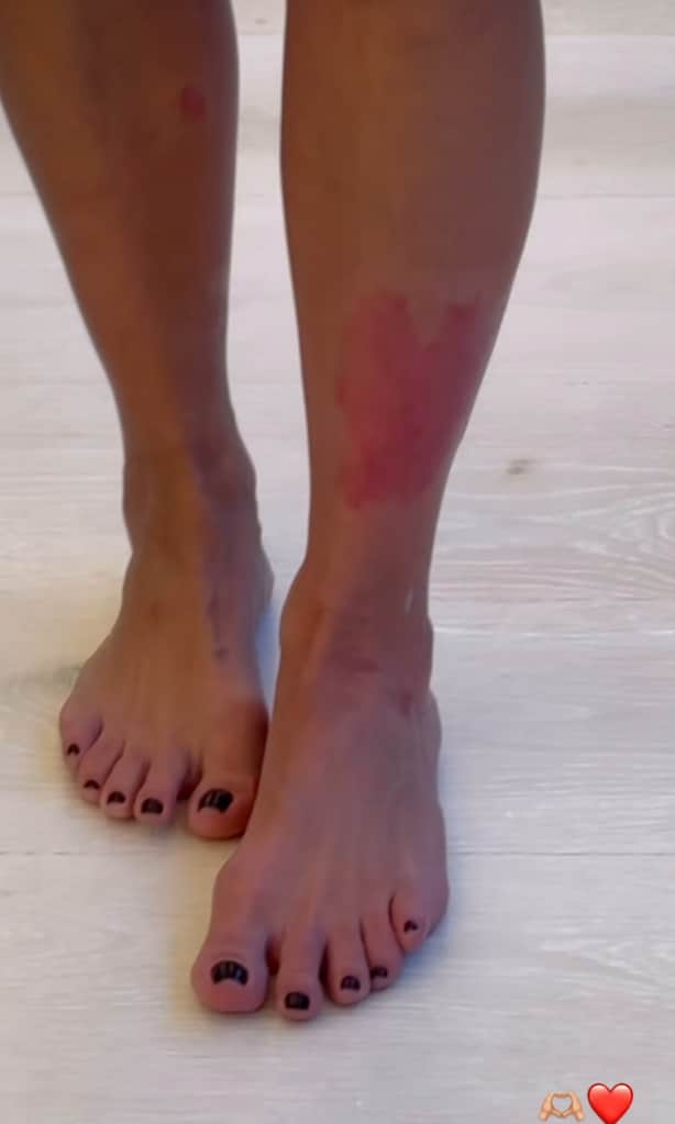 Kim Kardashian gets candid about her painful heart shaped psoriasis