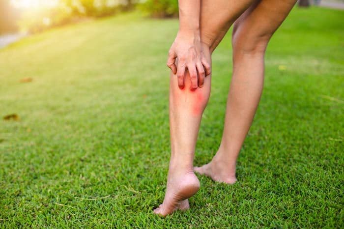 mujer rascando su piel en verano