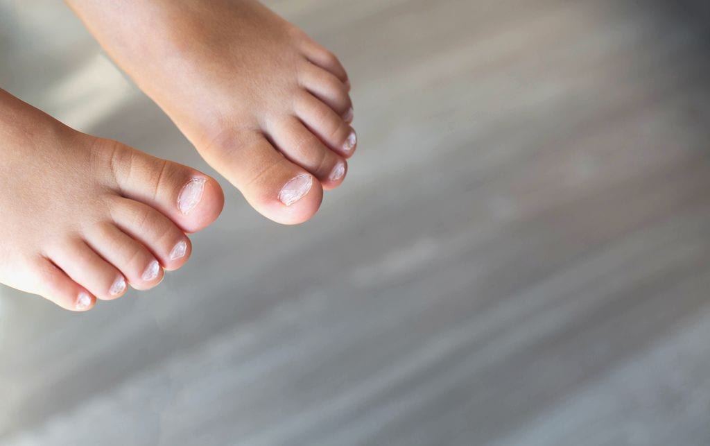 Uñas de los pies de un niño con alteraciones