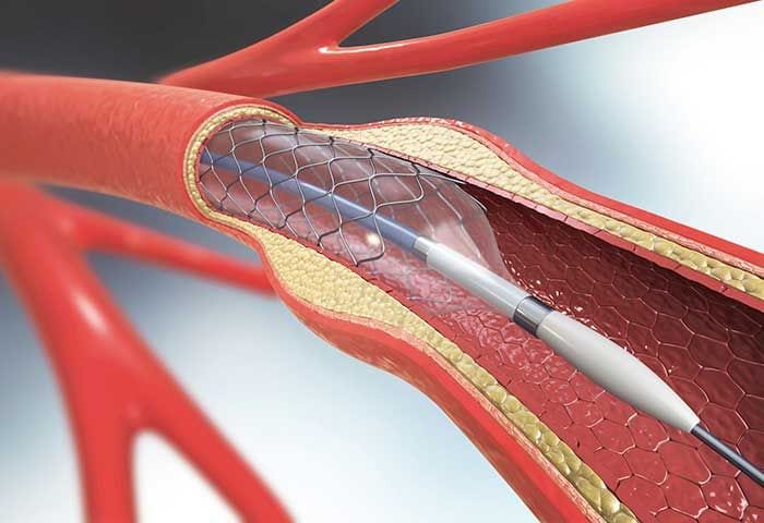 Imagen de un stent