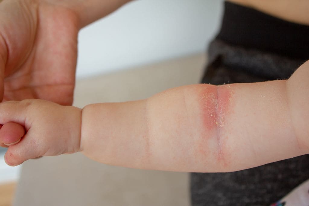 Brazo de bebé con lesiones cutáneas producidadas por la dermatitis