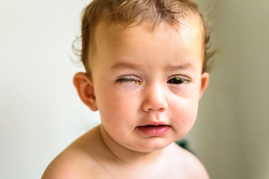 Bebé con conjuntivitis y legañas