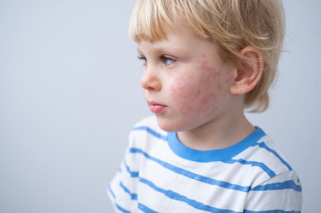 Niño con síntomas alérgicos en la cara