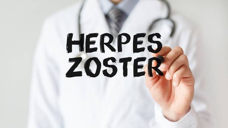 herpes zoster