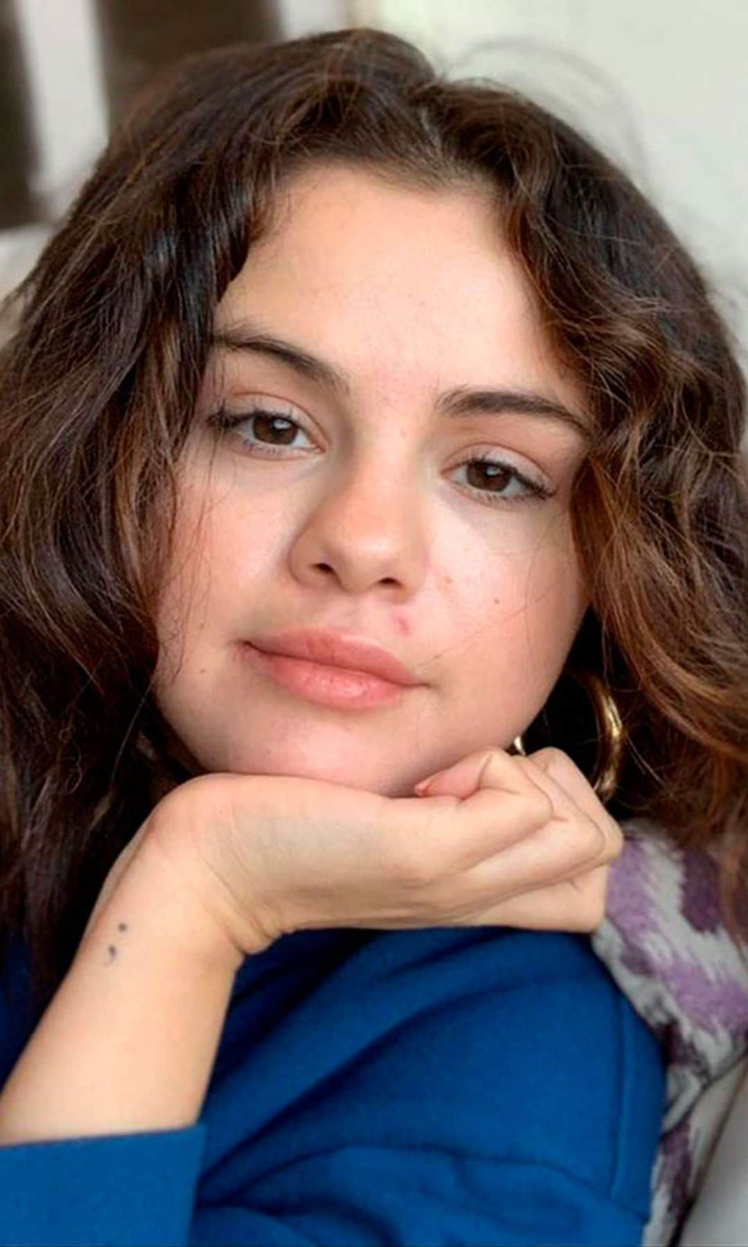 No es la primera vez que Selena Gomez hace público su problema con el acné