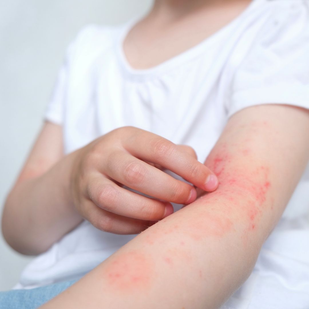 No es solo picor: así afecta la dermatitis atópica al estado de ánimo de los niños