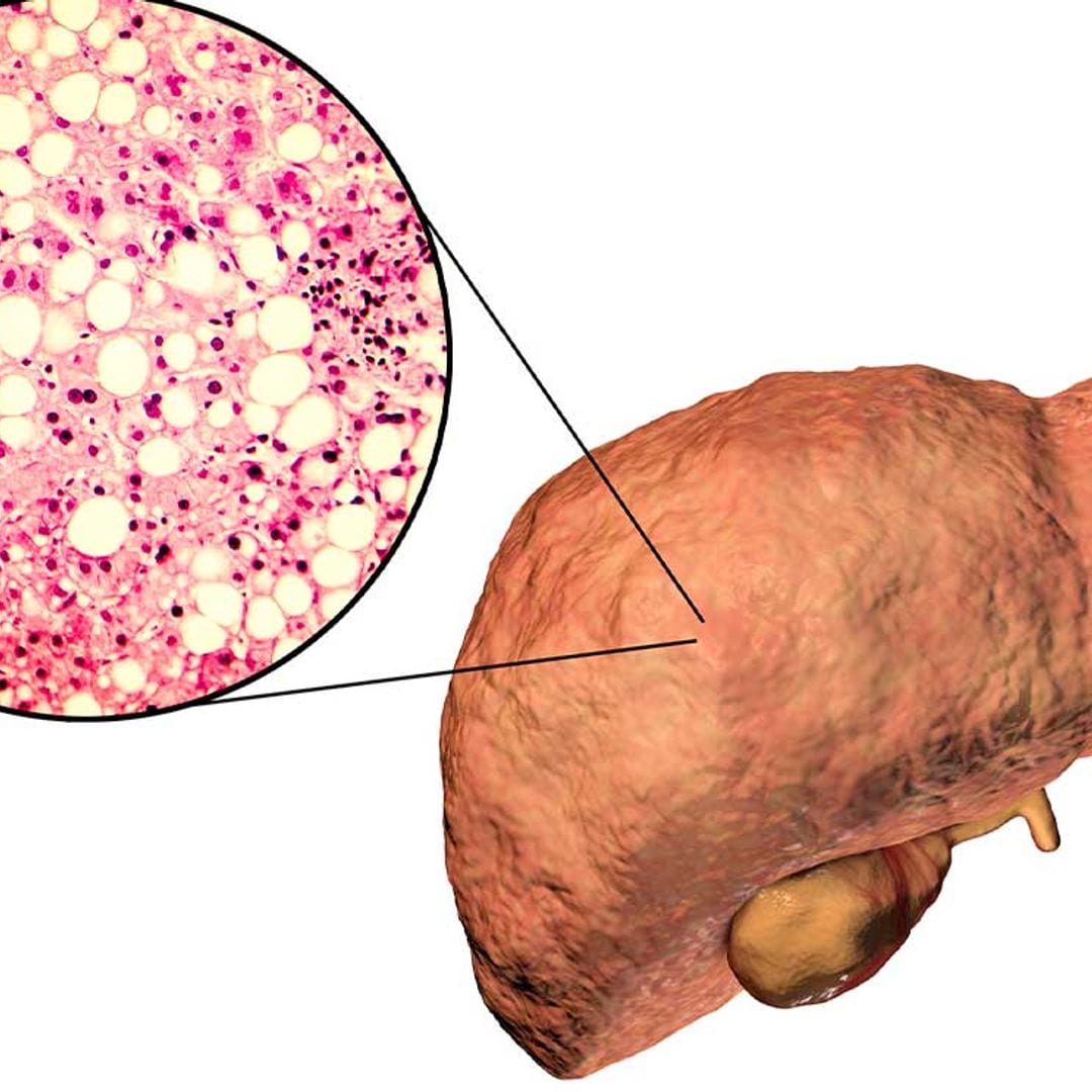 Hígado graso: qué es y cómo combatirlo