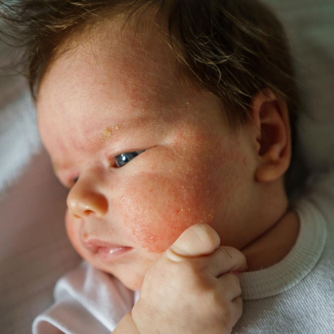 Los probióticos ¿pueden frenar los eccemas en bebés y niños?