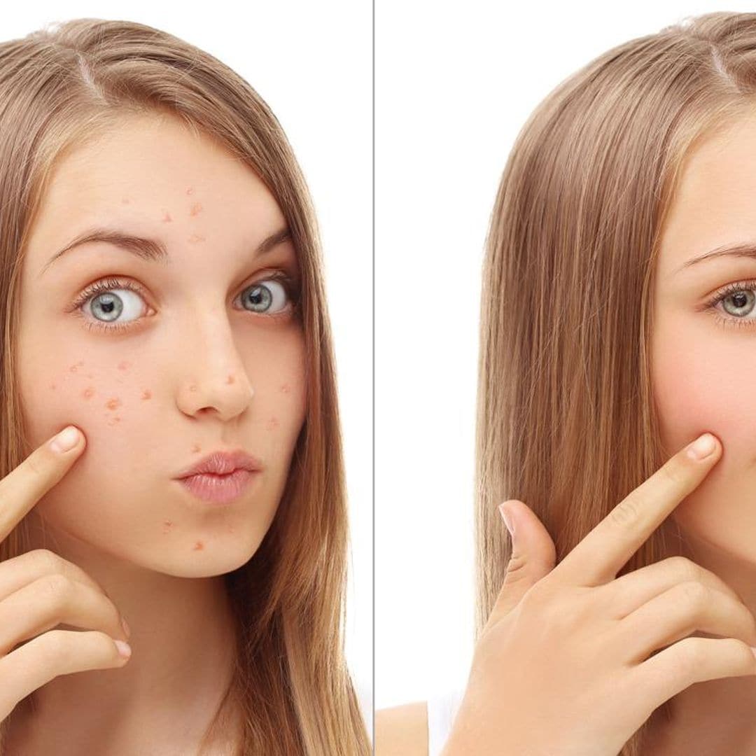 Elige entre 9 excelentes parches para eliminar el acné