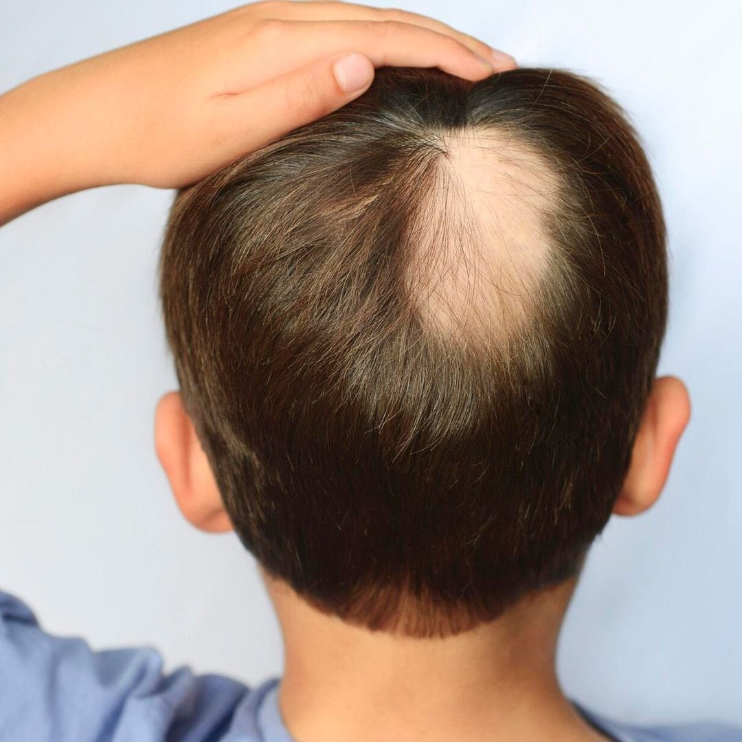 La alopecia areata, una enfermedad que hace que los menores de edad desarrollen calvicie