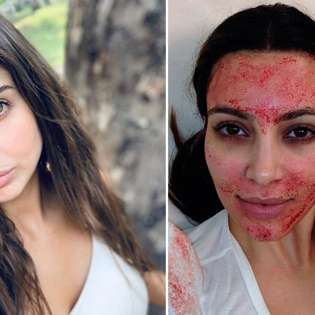 Michelle Renaud relató que se hizo el famoso 'facial vampiro', que Kim Kardashian puso de moda en 2013