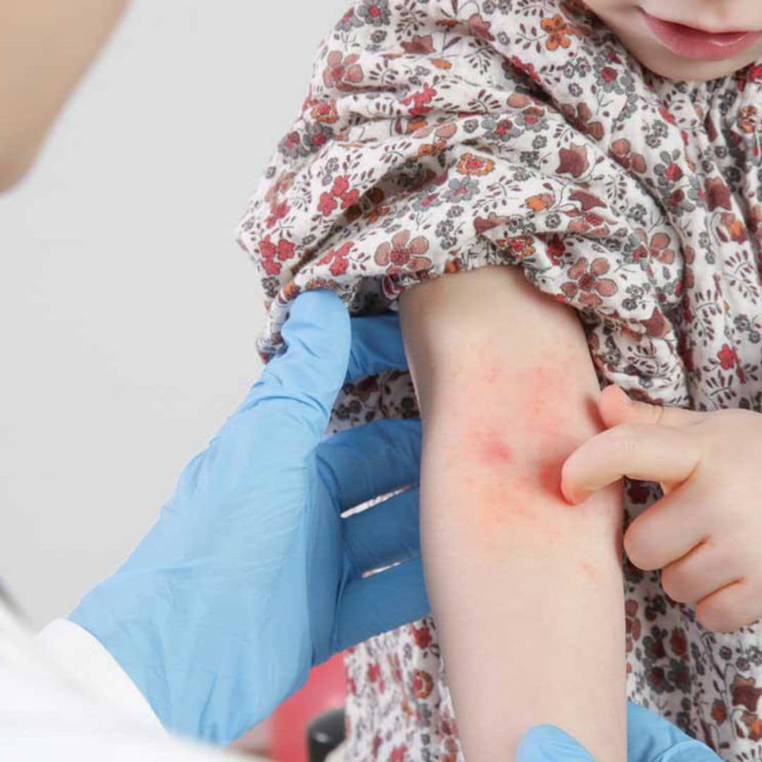 La psoriasis, más allá de una alteración en la piel: así afecta a los niños