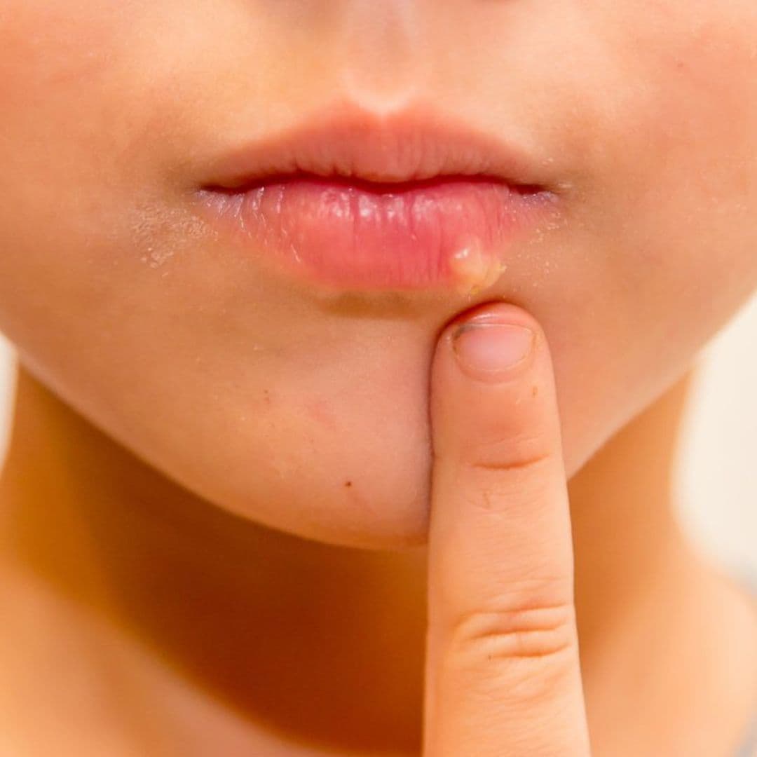 Herpes labial infantil, ¿consecuencia de un resfriado?