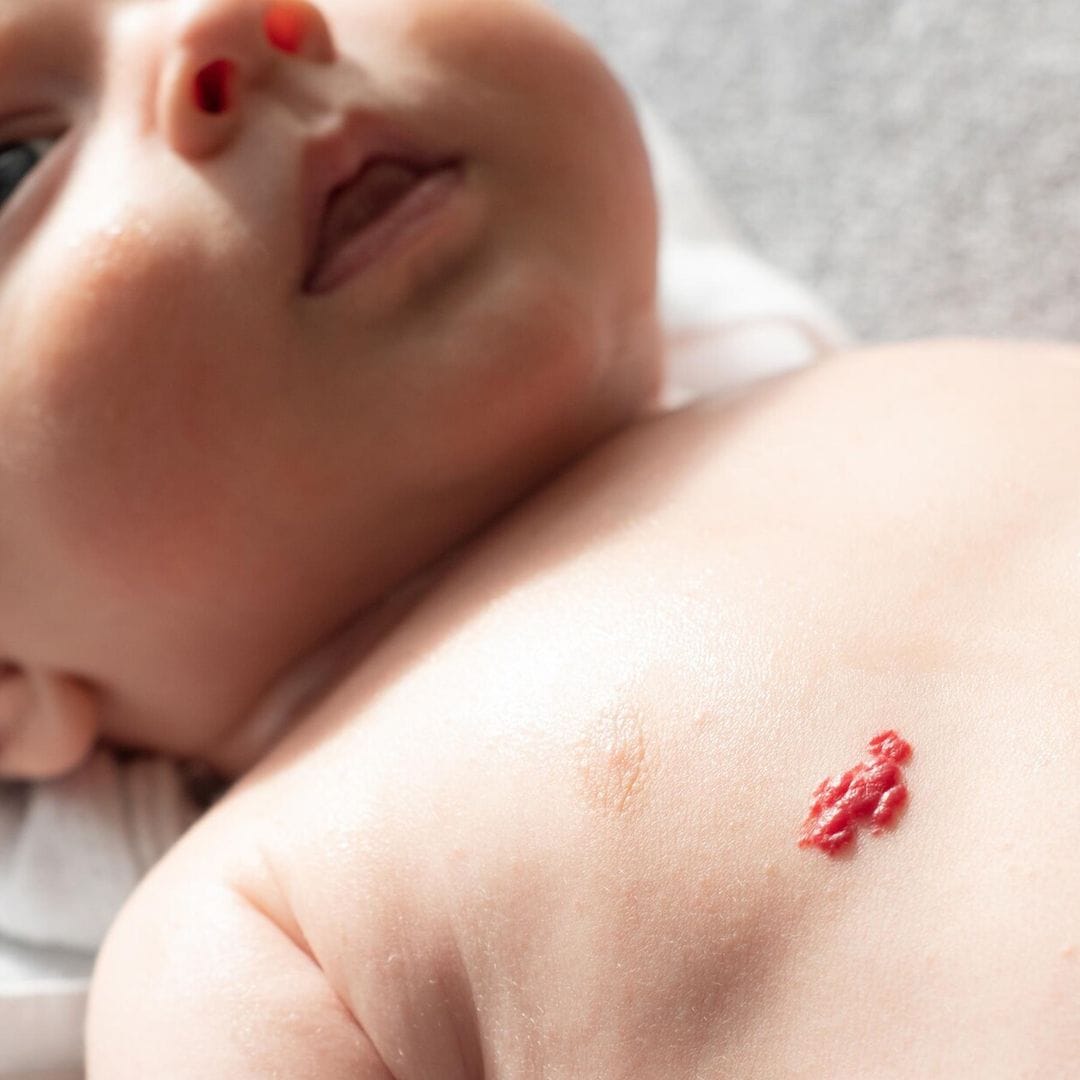 ¿Qué son los hemangiomas infantiles y cómo se tratan?