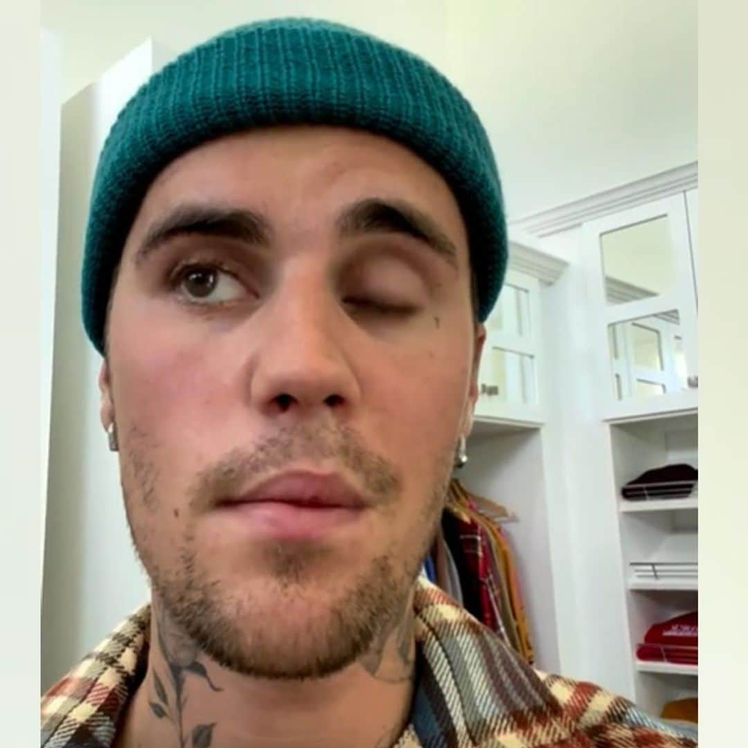 Justin Bieber comparte cómo evoluciona la incapacitante parálisis facial que sufre