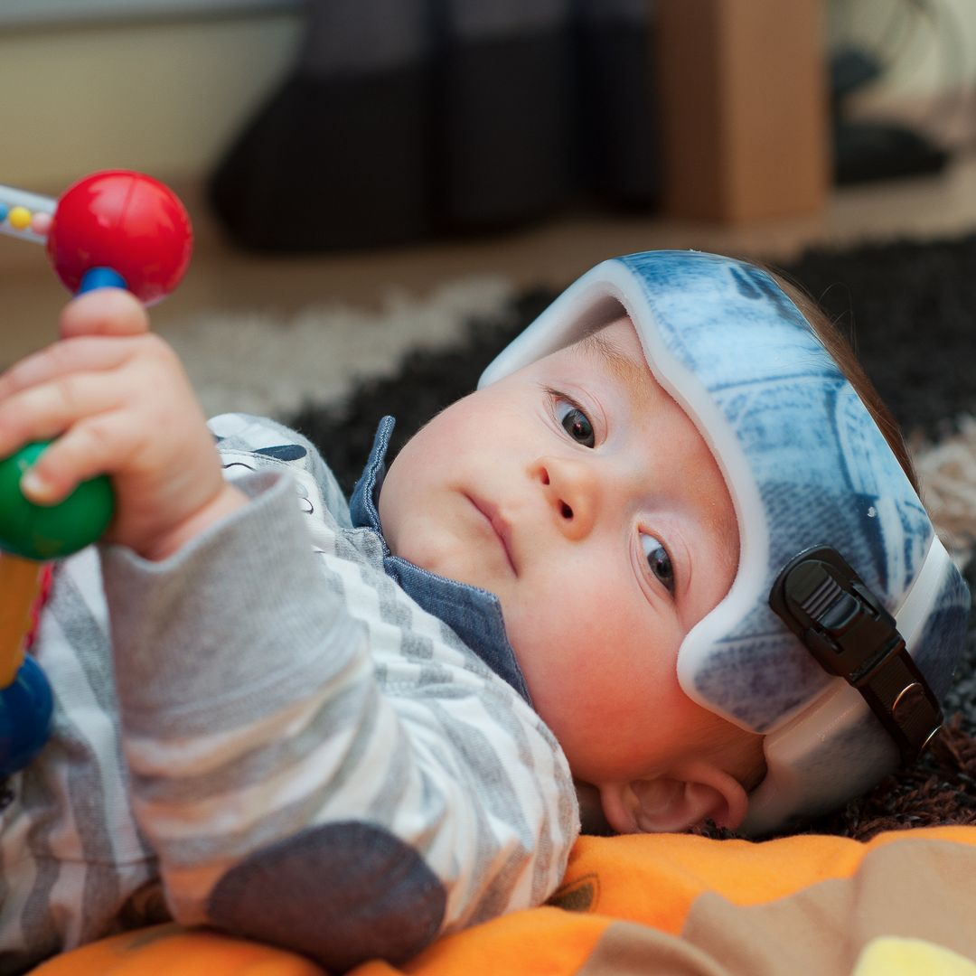 ¿Qué es la craneosinostosis? Conoce esta condición que puede afectar a los bebés