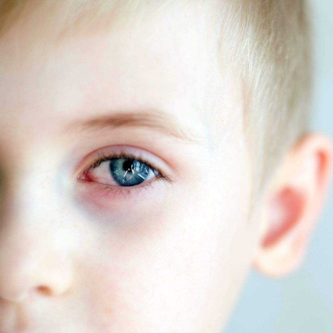 ¿Cómo diferenciar la conjuntivitis de los mocos en los ojos de los niños?