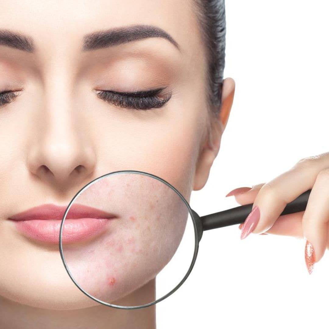 ¿Piel con acné? Mira los componentes que debes evitar en tu makeup